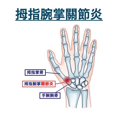 骨節手|手指痛、手腕痛！一圖簡單看懂，6種關節炎常見部位。